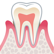 軽度歯周炎