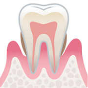 中等度歯周炎