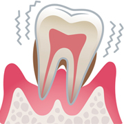 重度歯周炎